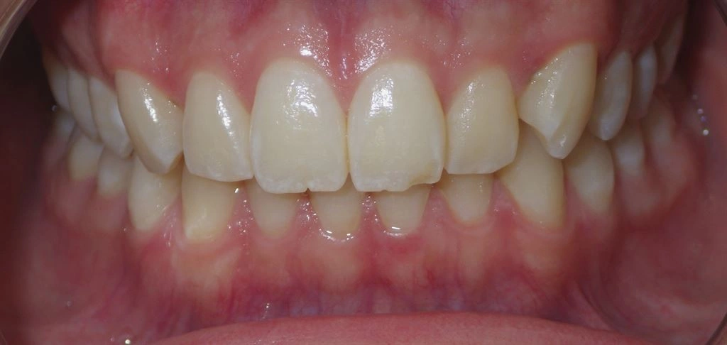 Dental Resin Composite at Luxe Smiles, Palmetto Bay, Miami